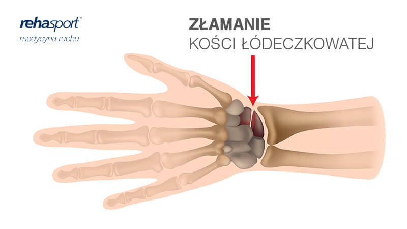 Złamanie kości łodeczkowatej