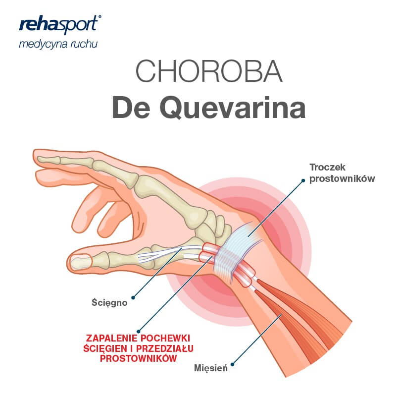 Choroba De Quevarina