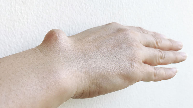 Ganglion