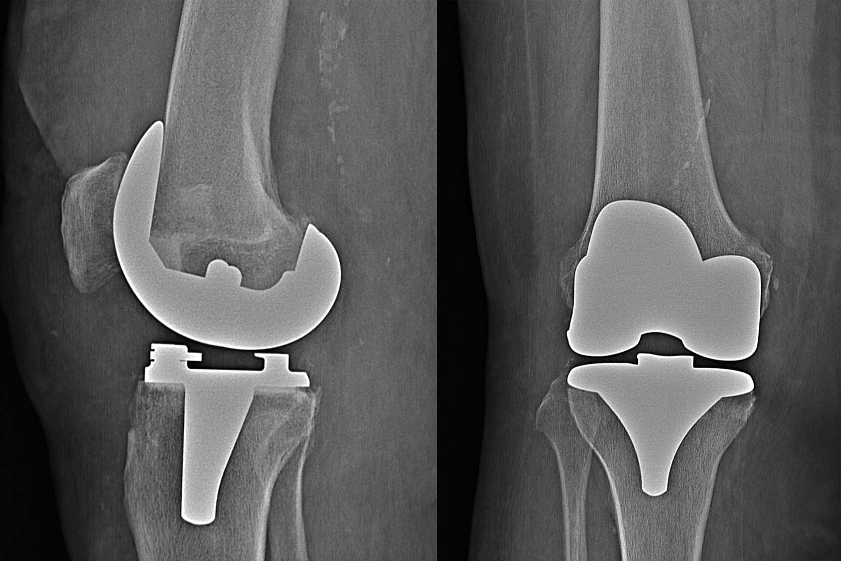 Zdjęcie RTG - endoproteza kolana