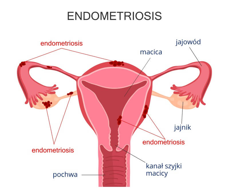 bol endometrioza u zglobovima