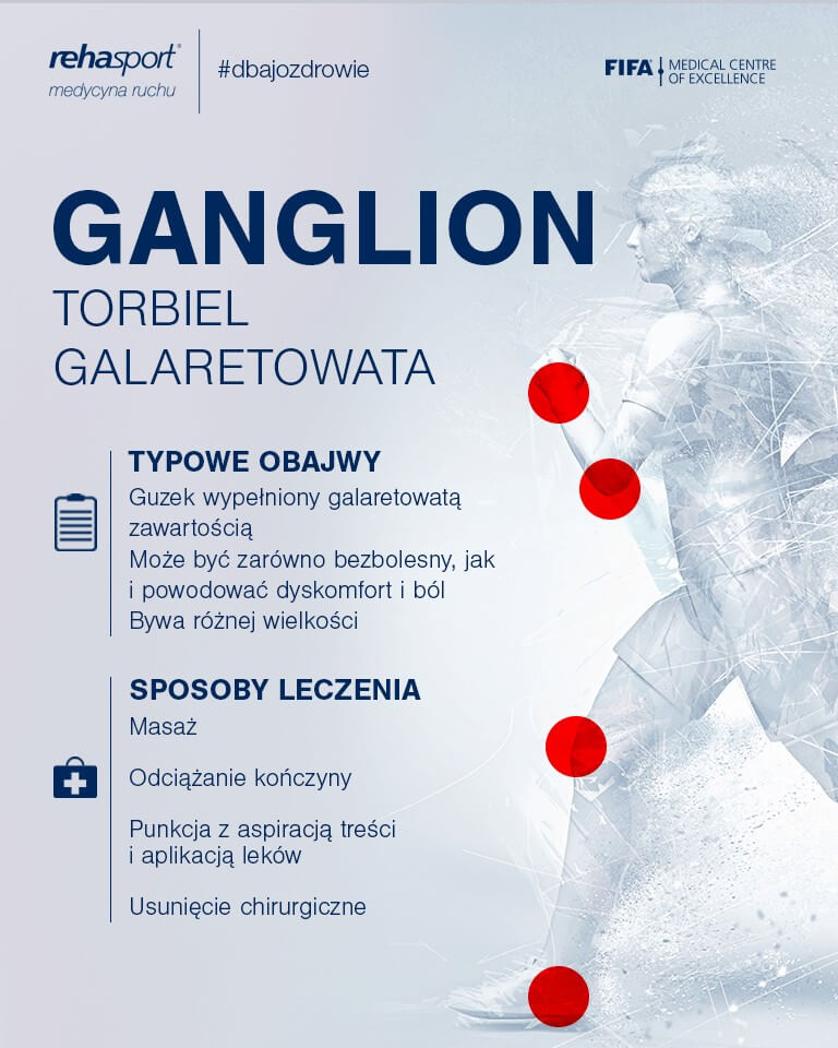 Ganglion - objawy, sposoby leczenia