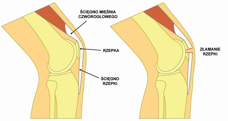 Ból z przodu kolana spowodowany złamaniem rzepki 
