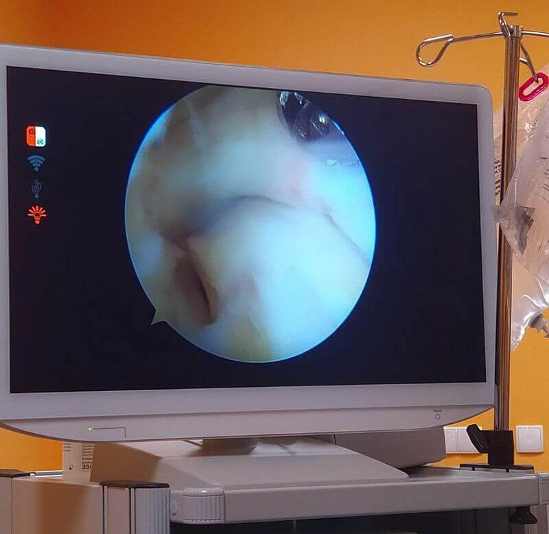 Artroskopia stawu skokowego