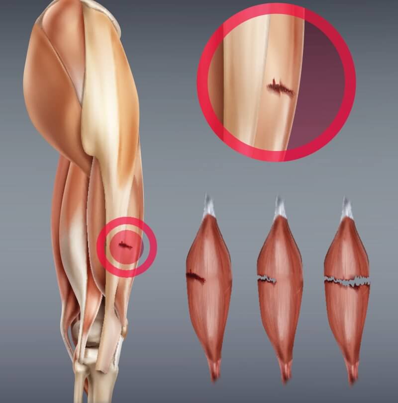 Trzystopniowa klasyfikacja urazu mięśnia