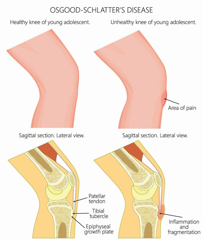Osgood Schlatter Disease In Young Athletes Osgood Schlatter Disease In Young Athletes