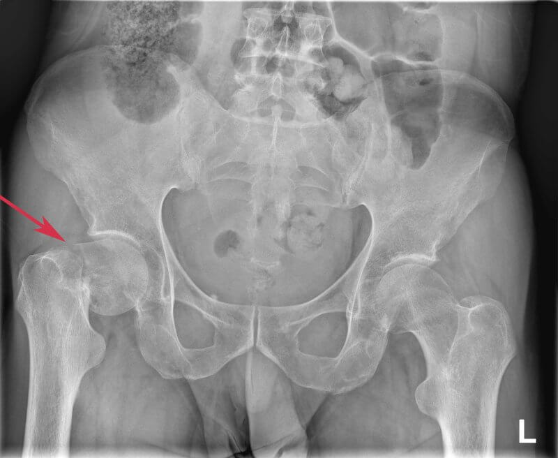 Złamanie szyjki kości udowej - RTG