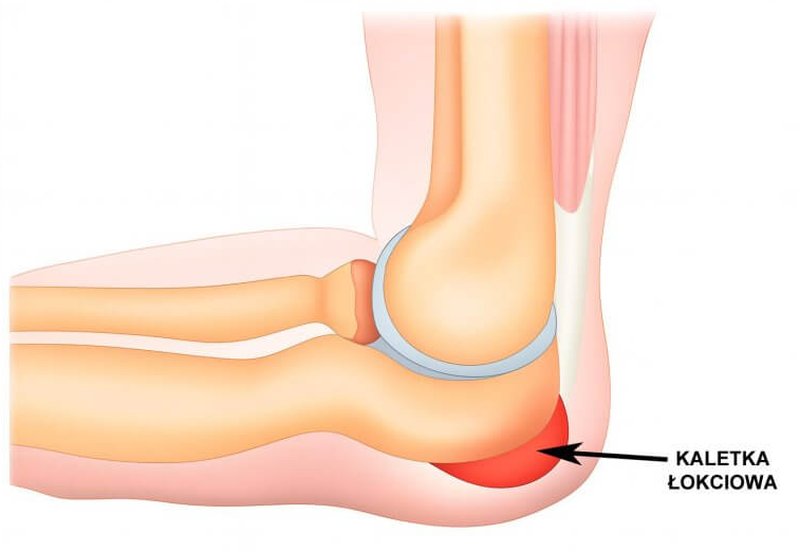 Zapalenie kaletki łokciowej
