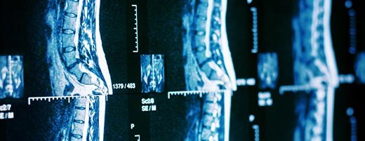 Stabilizacja kręgosłupa lędźwiowego