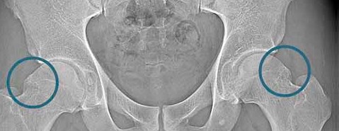 Konflikt udowo-panewkowy