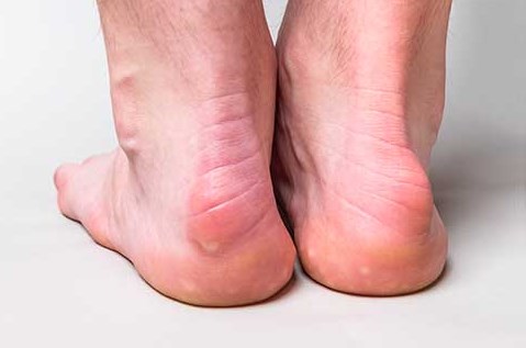 Ból pięty przy chodzeniu. Jak wyleczyć bolące pięty?