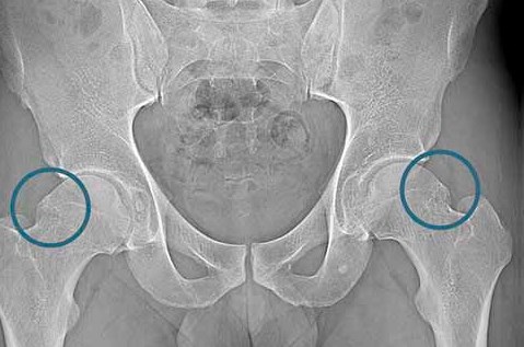 Konflikt udowo-panewkowy