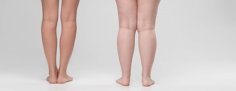 Kolana koślawe u&nbsp;dziecka