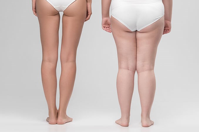 Kolana koślawe u&nbsp;dziecka, jak rozpoznać i&nbsp;leczyć