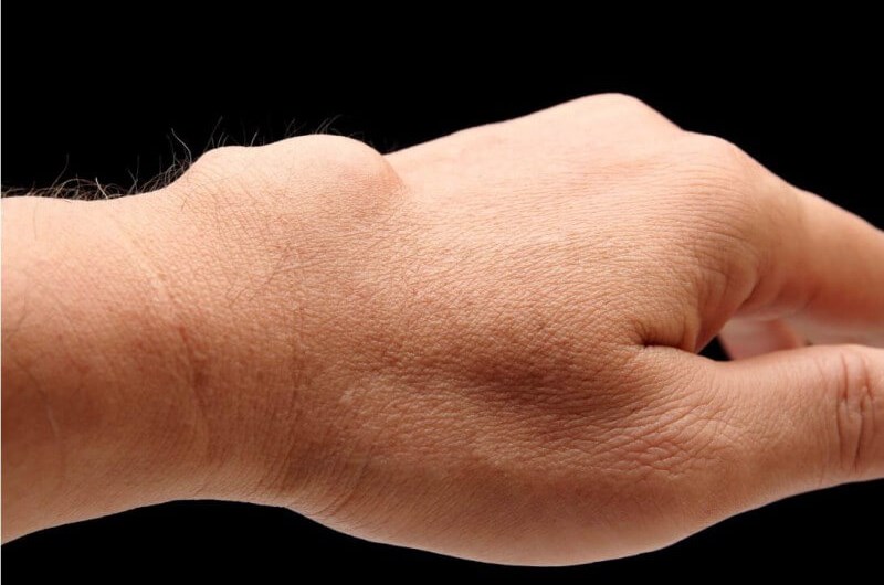 Ganglion - przyczyny, leczenie