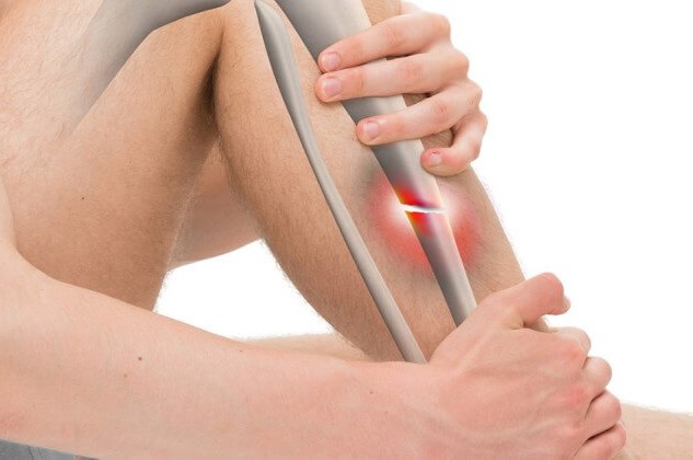 Złamanie zmęczeniowe