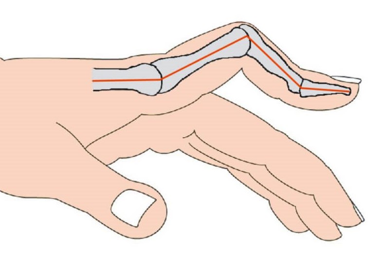 Palec butonierkowaty – objawy, diagnoza, leczenie