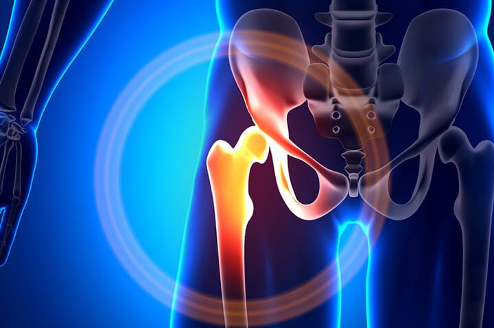 Endoproteza stawu biodrowego