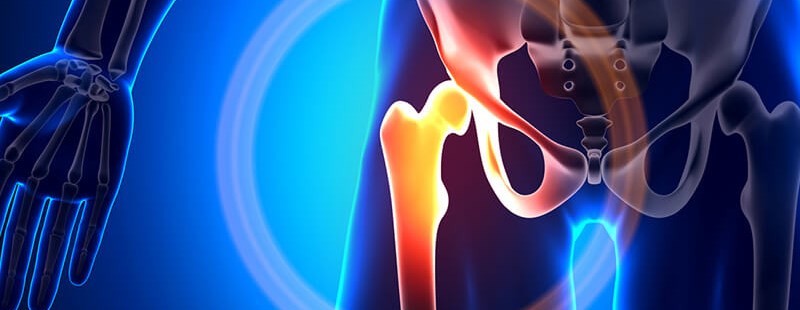 Endoproteza stawu biodrowego