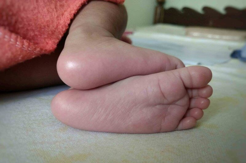 Pięta Haglunda | Choroba Haglunda-Severa