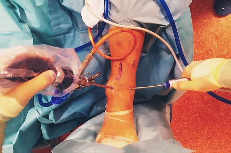 Artroskopia stawu skokowego