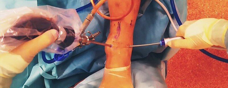 Artroskopia stawu skokowego