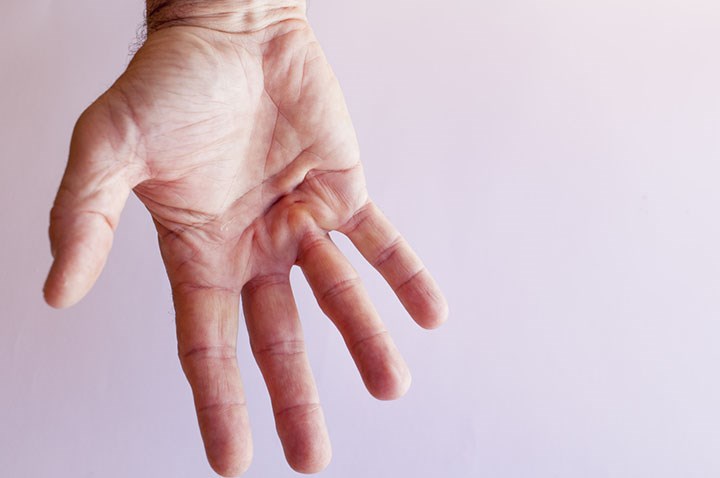 Choroba Dupuytrena - leczenie