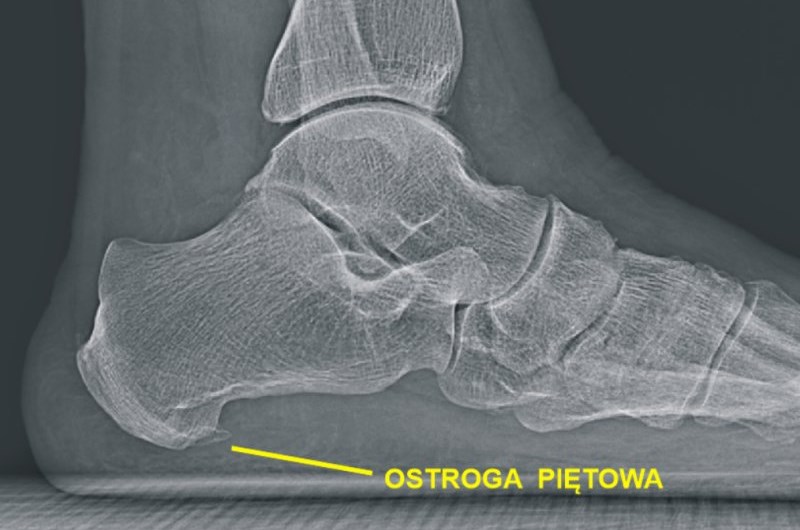Ostroga piętowa - przyczyny, objawy i&nbsp;leczenie
