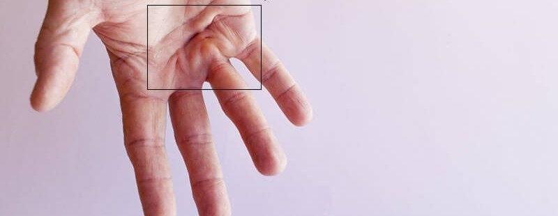 Dupuytren's disease