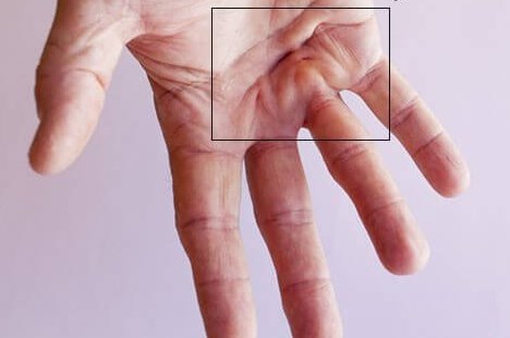Dupuytren's disease