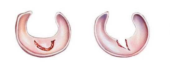 Meniscus Injuries