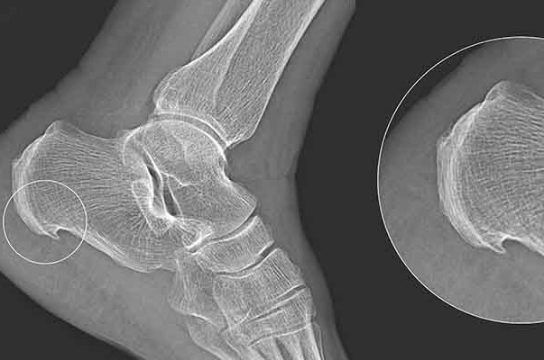 Heel Spur