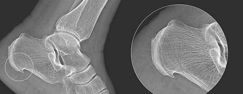 Heel Spur