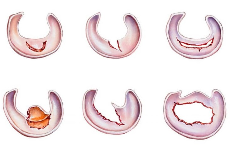 Knee Meniscus – How to Treat Meniscus Injuries