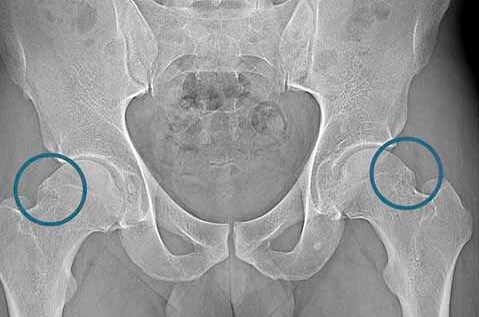 Femoroacetabular Impingement