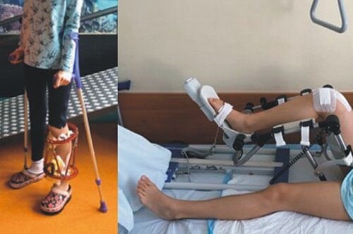 Limb Lengthening Surgery