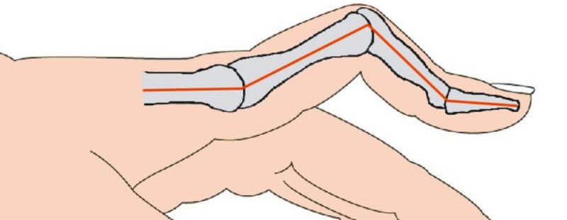 Boutonniere Deformity