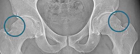 Femoroacetabular Impingement