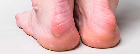 Heel Pain