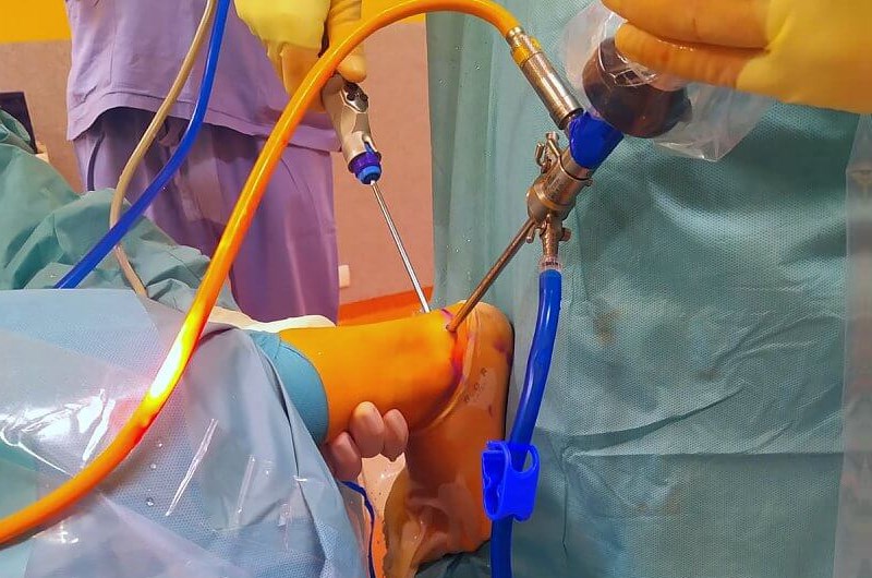 Ankle Arthroscopy