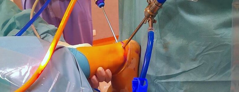 Ankle Arthroscopy