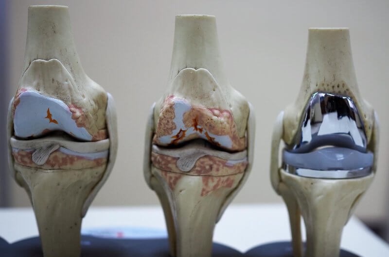 Knee Endoprosthesis