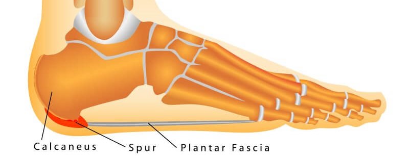 Plantar Fasciitis