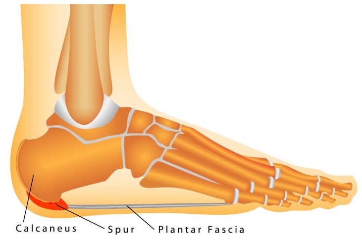 Plantar Fasciitis