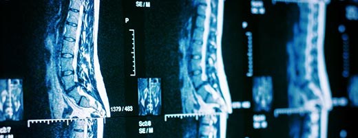 Lumbar Spine Stabilization