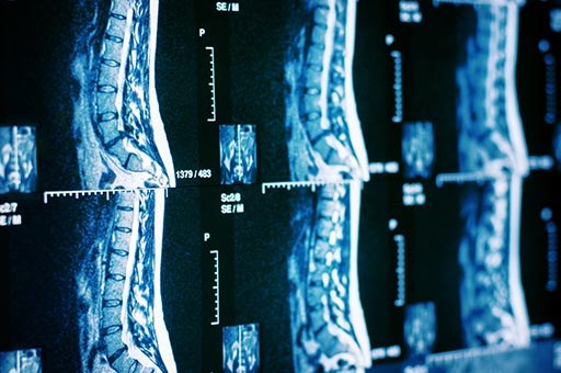 Lumbar Spine Stabilization