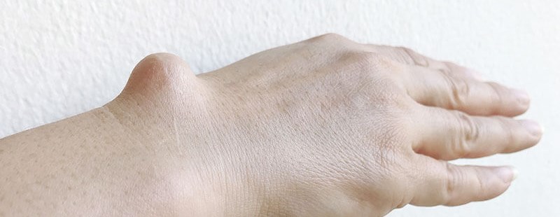 Ganglion