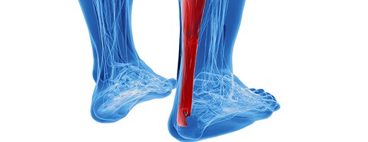 Achilles tendon rupture