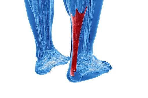 Achilles tendon rupture