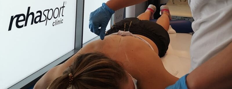 Dry needling
